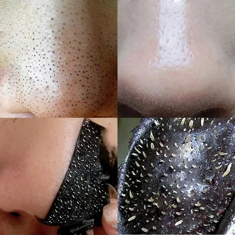 Blackhead Removal Mask - Shrinks Pores, Cleans Nose Lines, Skin Care Patch - Beauty & Beyond
