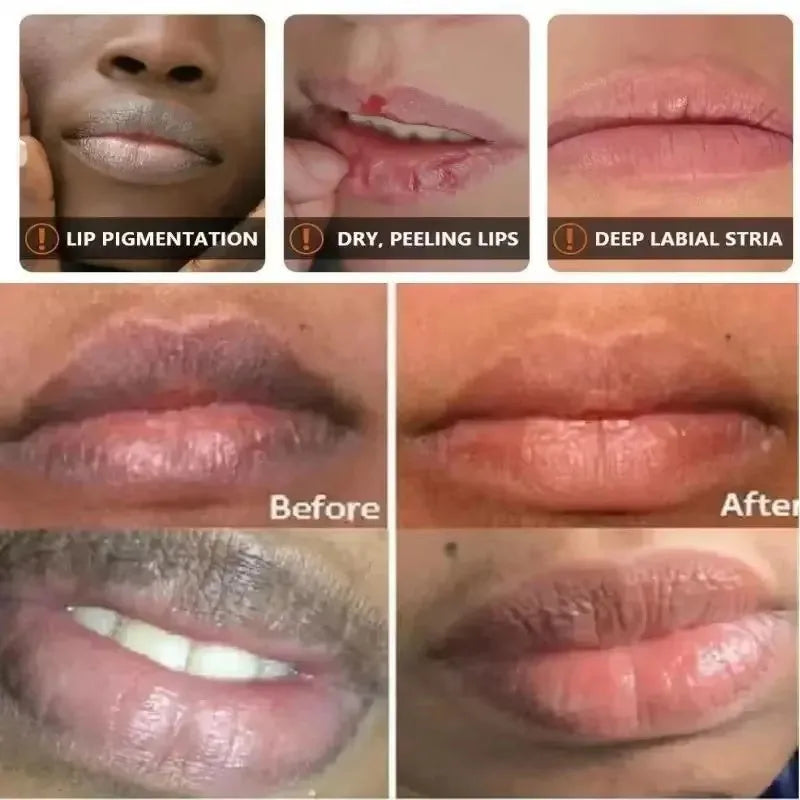Dark Lip Balm - Lightening, Melanin Removal, Exfoliating, Pink Lip Treatment, Moisturizing - Beauty & Beyond