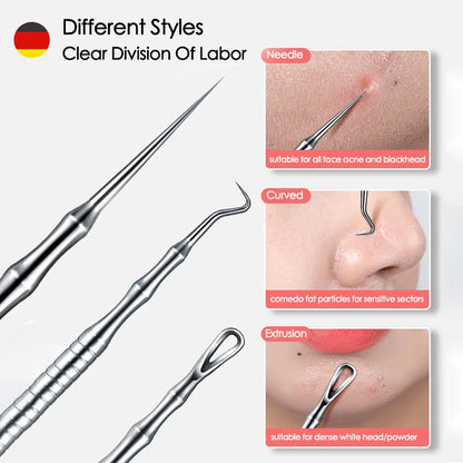 Blackhead Remover Tool – Precise Acne Extractor Tweezers for Deep Pore Cleaning