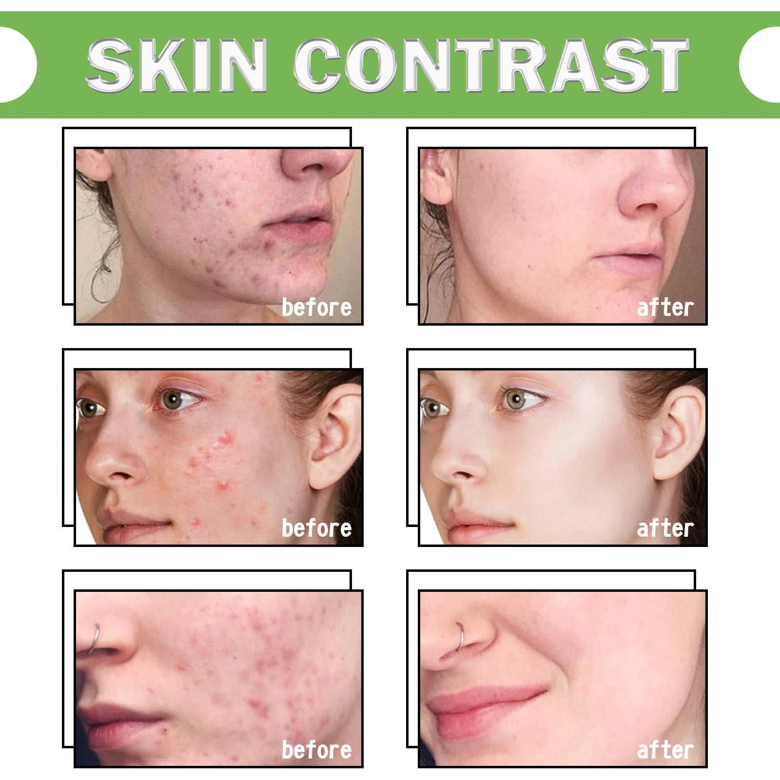50ml Acne Repair Gel – Exfoliating, Oil Control & Pore Minimizing Face Care - Beauty & Beyond
