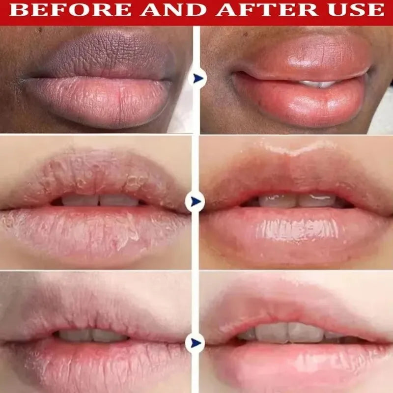 Dark Lip Balm - Lightening, Melanin Removal, Exfoliating, Pink Lip Treatment, Moisturizing - Beauty & Beyond