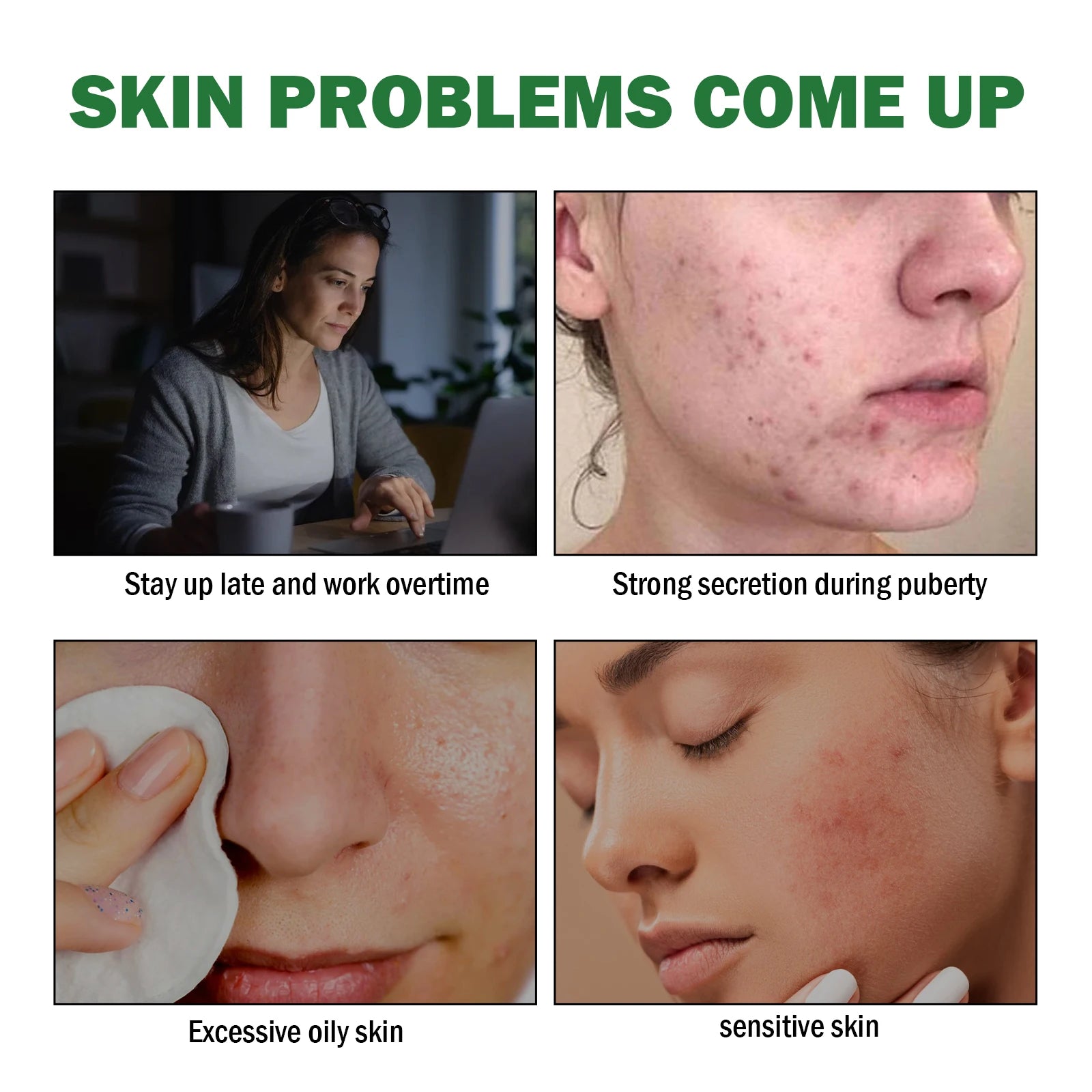 50ml Acne Repair Gel – Exfoliating, Oil Control & Pore Minimizing Face Care - Beauty & Beyond