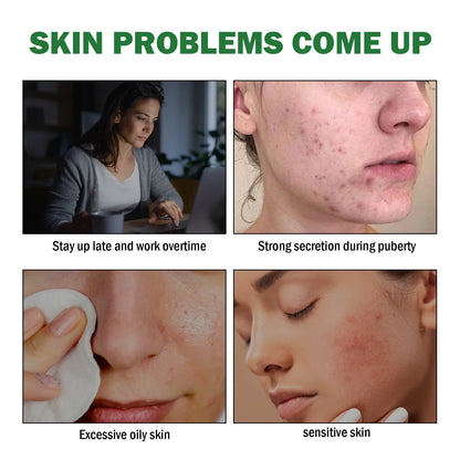 50ml Acne Repair Gel – Exfoliating, Oil Control & Pore Minimizing Face Care - Beauty & Beyond